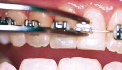 AAO | Handling Orthodontic Emergencies | Smiles by Design Orthodontist